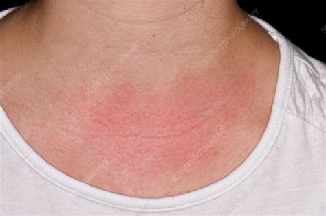 Allergic Reaction To Chest Rub Stock Image C0345324 Science