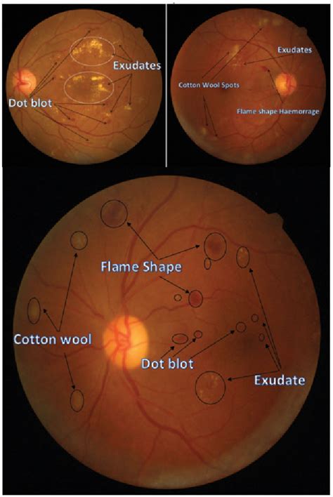 Clinically Significant Macular Edema