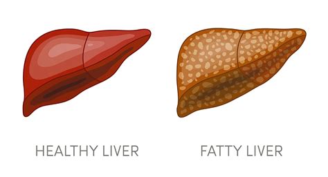 6 Common Causes Of A Fatty Liver Liver Doctor