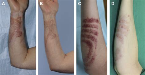 Scar Management Of The Burned Hand Hand Clinics
