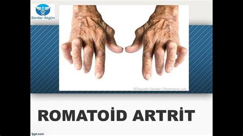 Romatizma nedir Romatoid artrit nasıl olur belirtileri tedavisi