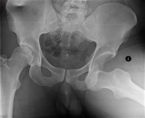 Hip Dislocation Orthopedics Medbullets Step 23