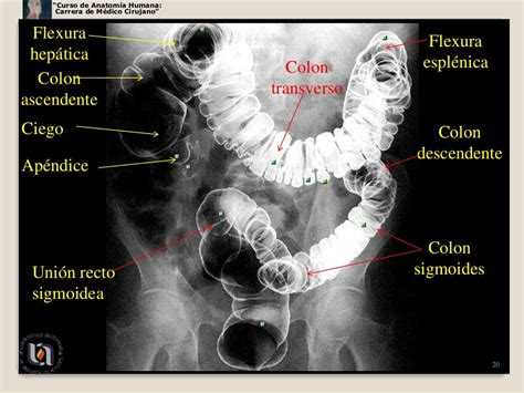 Flexura Esplênica Do Cólon