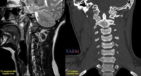 Saem Clinical Images Series A Rare Cause Of Post Traumatic Neck Pain