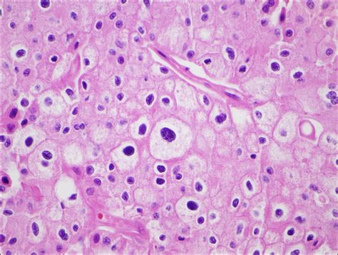 Chromophobe Renal Cell Carcinoma Mypathologyreportca
