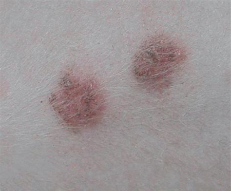 Dermatophytosis And Papular Eosinophilicmastocytic Dermatitis