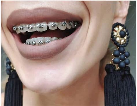 How Much Do Braces Cost In South Africa 2020 Find It Out Here