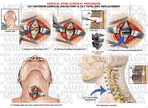 1 Level C6 C7 Anterior Cervical Discectomy And Fusion Cervical