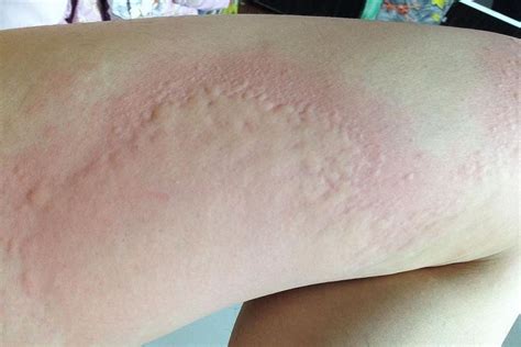 Anaphylaxis After Eating Dust Mites Rashes Remedies Allergy Remedies