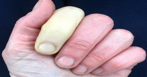 beware of the disease that causes your toes and fingers to turn white and blue when it is cold