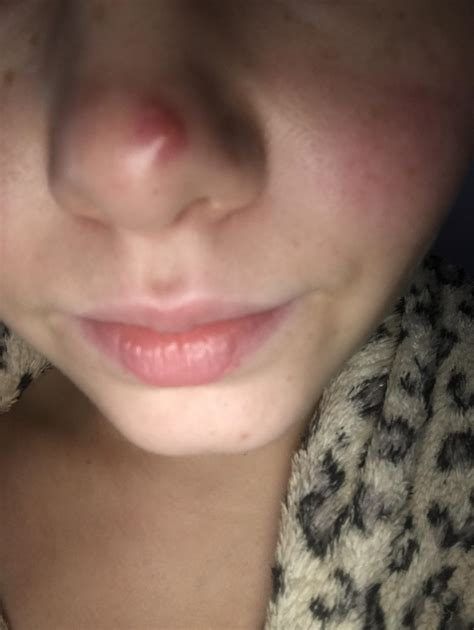 Help Huge Red Pimple On My Nose For 6 Weeks General