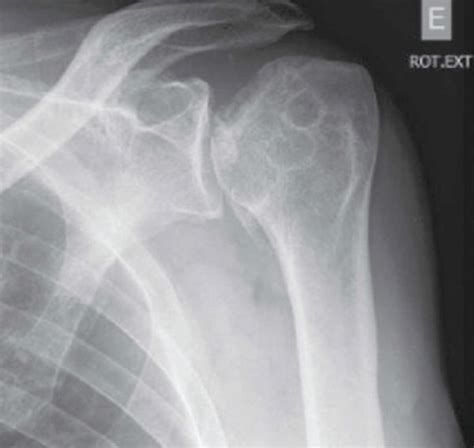 Anteroposterior Plain Radiograph Of The Left Shoulder With The Crescent