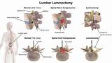 Lumbar Laminotomy Recovery Time Images
