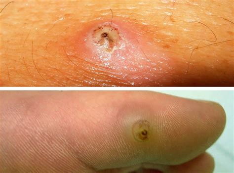 Unique What Do Sand Fleas Bites Look Like