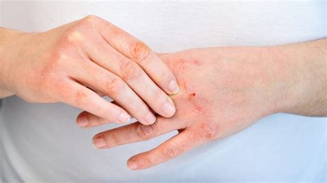 Atopic Dermatitis Eczema Bvaac Dr Paul Jantzi