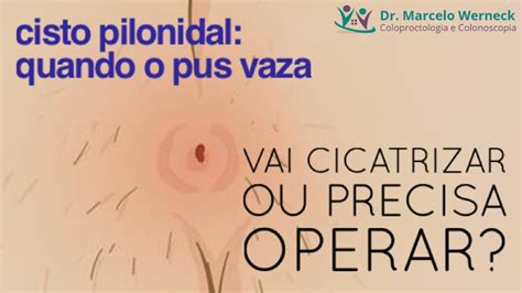 Cisto Pilonidal Cura Sozinho