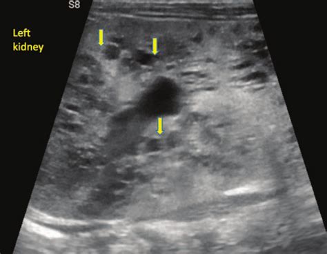 The Ultrasound Aspect Of Cystic Lesions In The Left Kidney At The Time