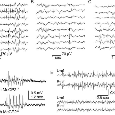Dravet Syndrome A Interictal Eeg In A 17 Month Old Patient With An