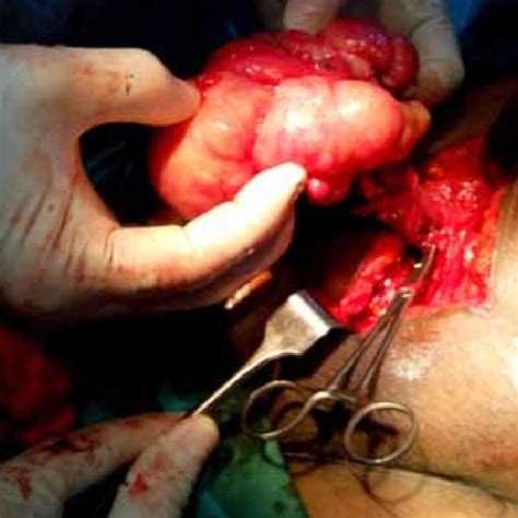 Strangulated Indirect Left Inguinal Hernia With Torsion Of A