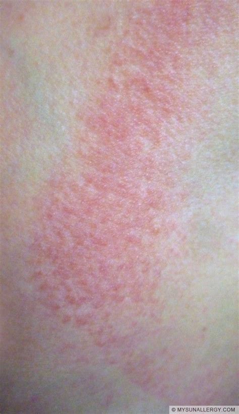 Polymorphous Light Eruption PMLE Pictures And Sun Allergy Rash Images