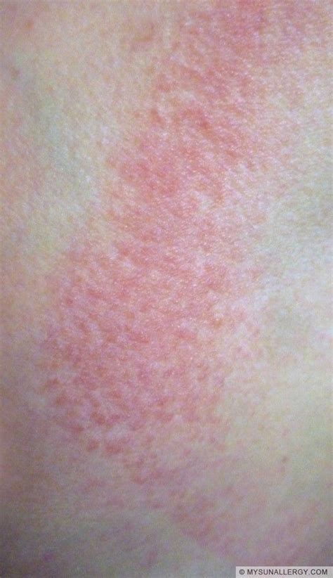 Polymorphous Light Eruptionpmle Pictures And Sun Allergy Rash Images