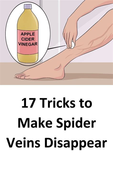 17 Tricks To Make Spider Veins Disappear Natural Skin Care Remedies Spider Veins Organic