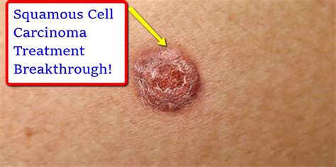 Squamous Cell Carcinoma Treatment Breakthrough Youtube