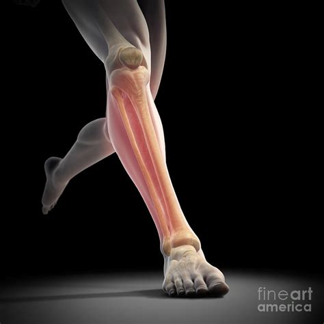 Medial Tibial Stress Syndrome Photograph By Science Picture Co Pixels
