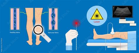 Endovenous Laser Treatment Cvd Treat Elt Legs Inject Evlt Varicose