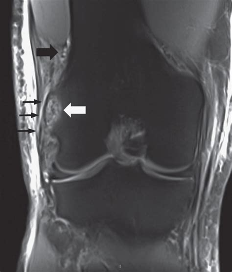 Patient Case 2 A Ap Right Knee X Ray At Day 1 Showing The Avulsion