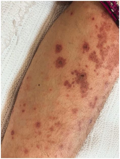Ceftriaxone Induced Leukocytoclastic Vasculitis A Case Report And