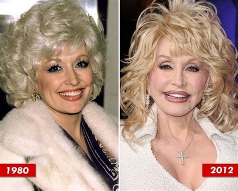 Dolly Parton before and after plastic surgery 01 ...