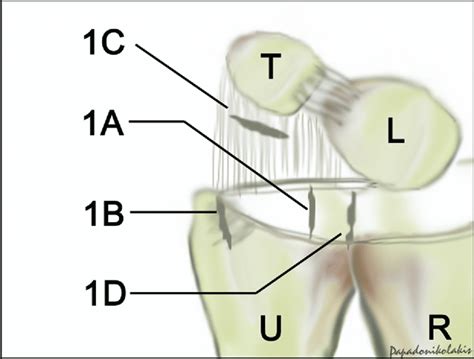 .their tfcc palmer 1b lesions and to compare their results with those of arthroscopic suture repair. Palmer classification of TFCC traumatic injuries: (A ...