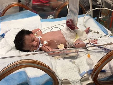 Miracle Baby Born With Intestines Outside His Body Celebrates First