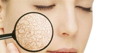 Peeling skin is an irritating condition. How To Get Rid Of Flaky Skin On Face: 9 Natural Ways (With ...