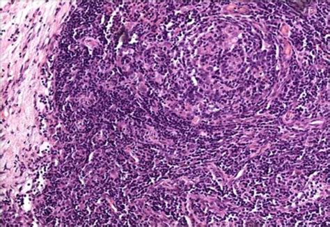 Castleman Disease Plasma Cell Variant Lymph Node Biopsy With Reactive