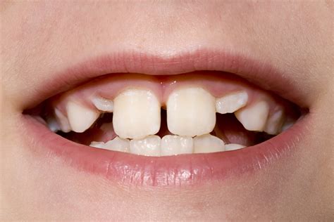 Which Teeth Are Considered Eye Teeth