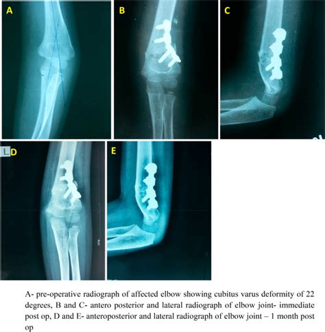 Functional Outcome Of Modified French Osteotomy Fixed With Recon