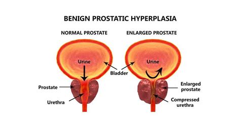 Benign Prostatic Hyperplasia Bph Mens Clinic Dr Tan And Partners