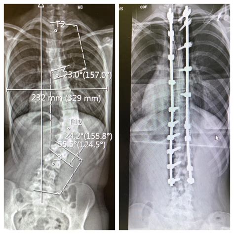 Sophias Scoliosis Story Scolios Us