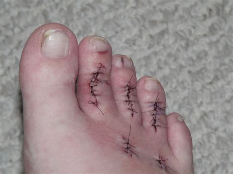 After Surgery Had Surgery For Hammer Toes On 112009 A