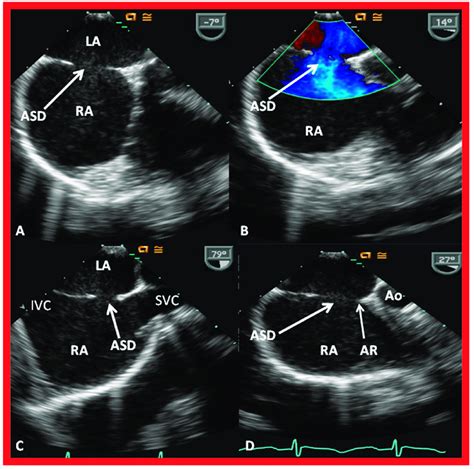 Transesophageal Echocardiographic Examination Demonstrating An Atrial
