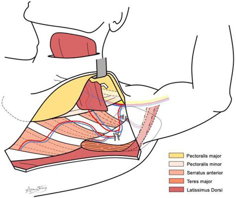 Anatomy Of Dissection For Pedicled Latissimus Dorsi Flap Demonstrating
