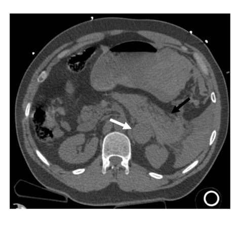 Ct Scan Of The Abdomen With Left Adrenal Mass White Arrow And