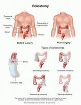 Colostomy Medical Definition Pictures
