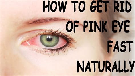 How To Get Rid Of Pink Eye Fast Conjunctivitis Naturally The Best