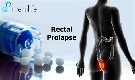 Rectal Prolapse Premilife Homeopathic Remedies