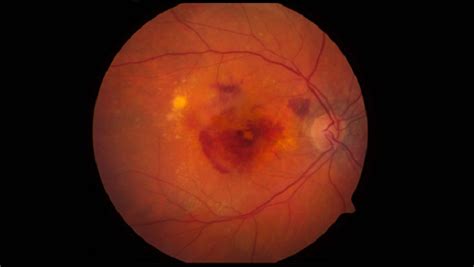 Macular Degeneration Searching For A Treatment