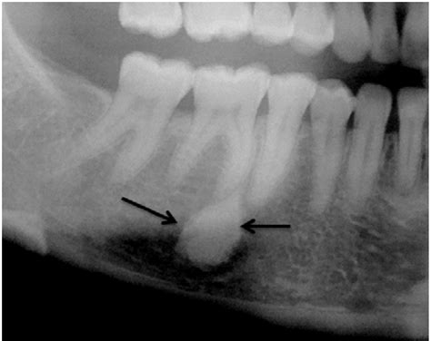 Idiopathic Osteosclerosis In Close Proximity To The Mesial Root Of