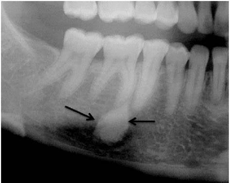 Bony Lesions | IntechOpen Картинка - Bony Lesions | IntechOpen